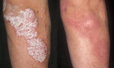 zdjęcia przed i po leczeniu łuszczycy